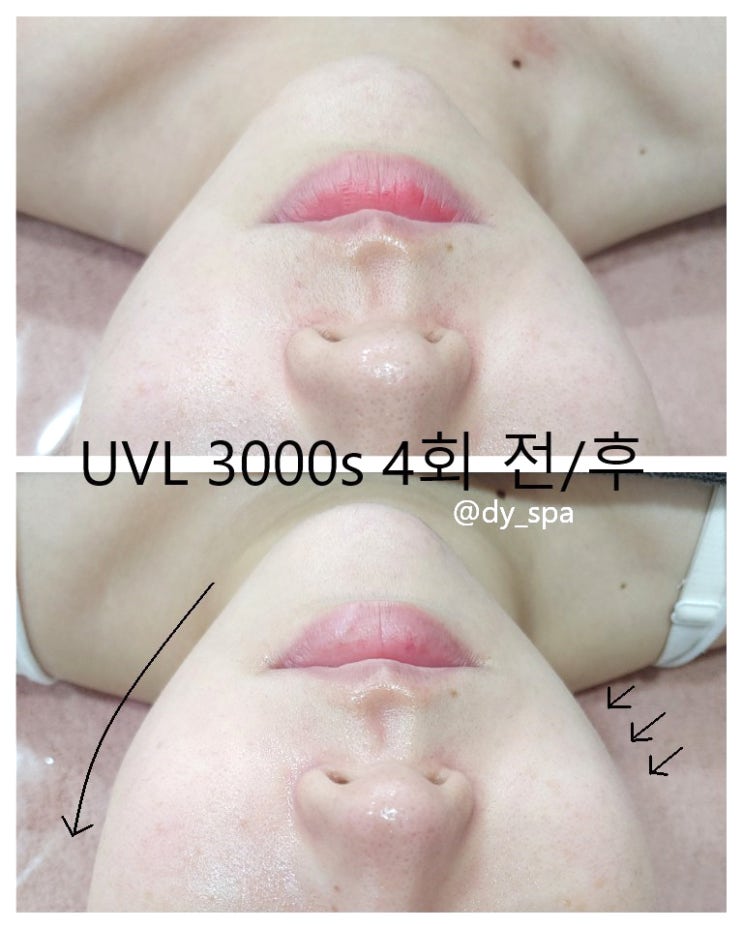  [서귀포시 수분빵빵, 팔자주름 리프팅 관리 할인혜택정보]최대 35% 즉시할인! 서귀포2청사 강정동!