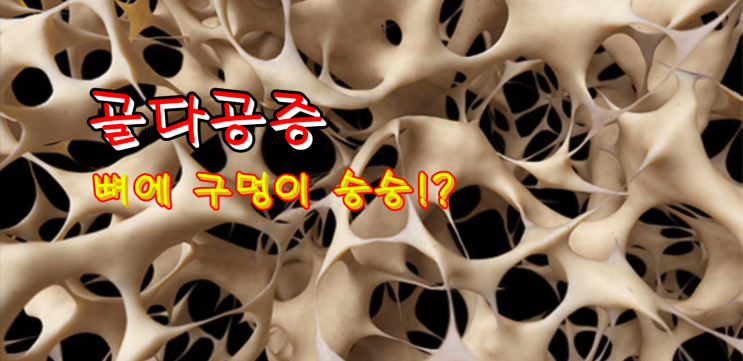  골다공증 원인과 증상, 예방법은?｜뼈에 구멍이 숭숭!?