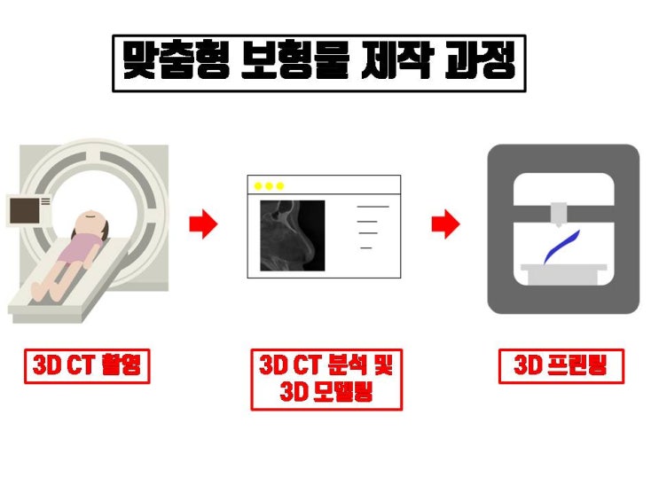  3D 맞춤 보형물을 이용한 코성형 물론 좋은 수술이죠. 근데 단점 없는 수술은 없죠.