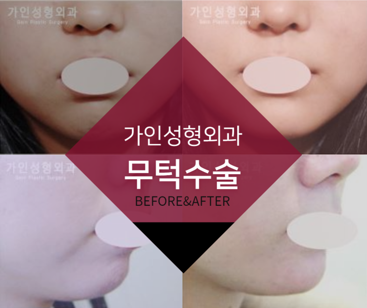  무턱수술 결과만 봐도 알 수 있어요