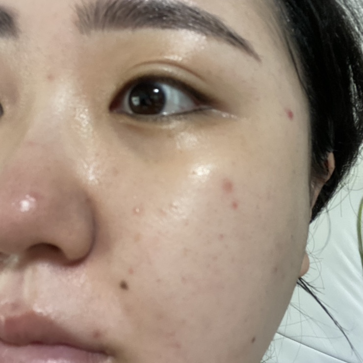  잡티, 여드름 붉은자국 청담동 피부과 다녀왔어요~ 레이저후기 1회차