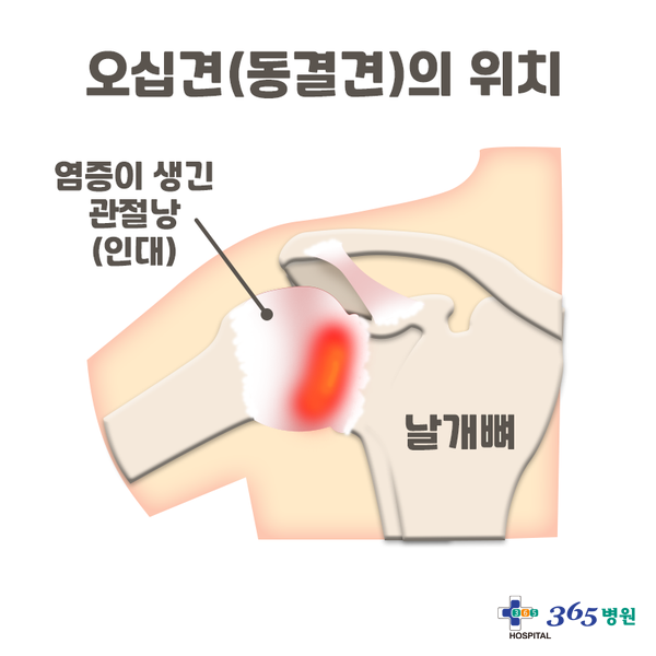  [창원마산 척추관절 디스크 365병원] 오십견(유착성 관절낭염/동결견)