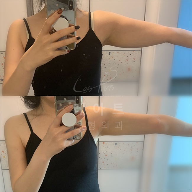  누구나 원하는 직각어깨 & 일자팔뚝 될 수 있어c