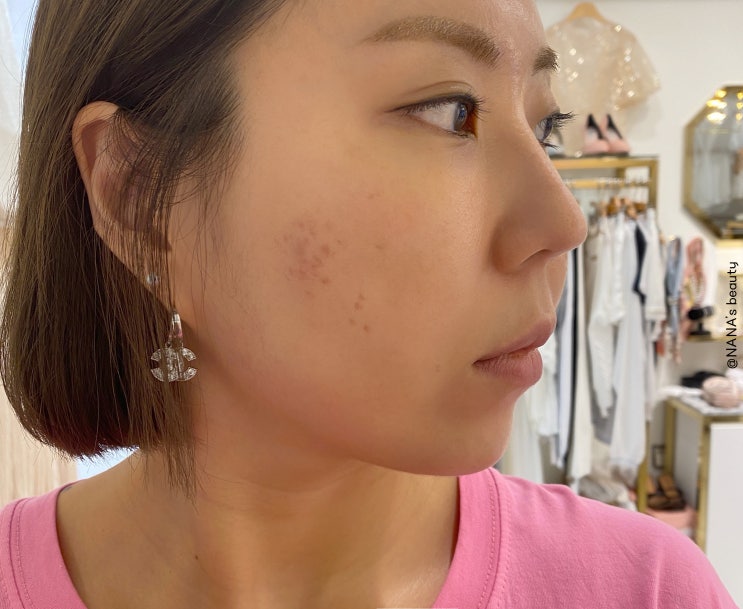 파인흉터/여드름흉터 새싹침 내돈내결 4회차 후기