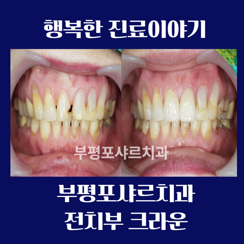 부평역 치과 크라운 보철 장단점 가격