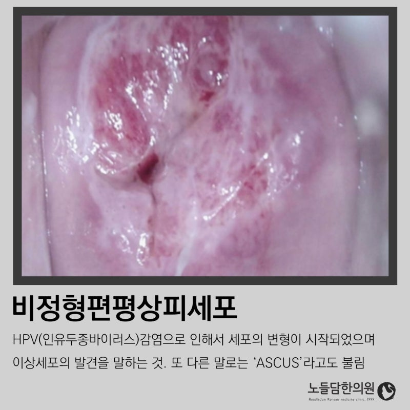 자궁이형성증 자궁경부용종 자궁혹 1