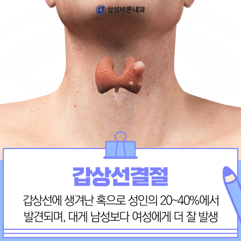 노원구갑상선외과 결절 크기와 치료여부는?