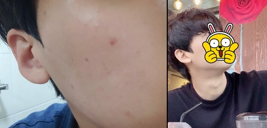  애크논 크림 가격 및 사용후기(병행하니 효과 2배!)