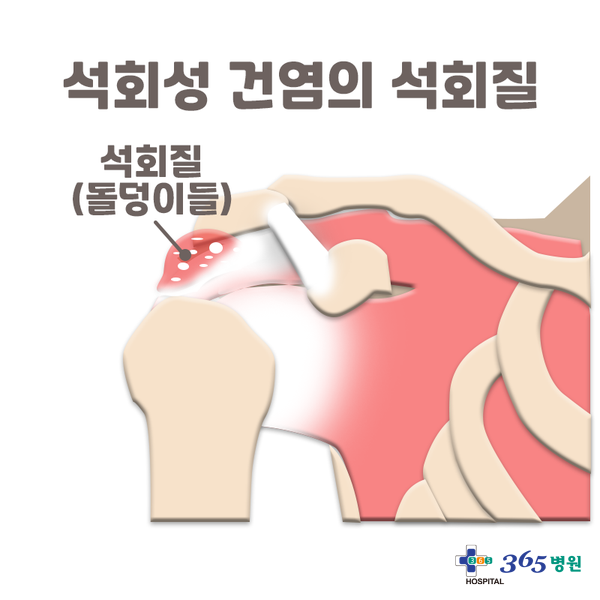  [창원마산 척추관절 디스크 365병원] 석회성 건염