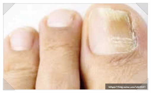손발톱 곰팡이 감염 증상과 예방 방법은?
