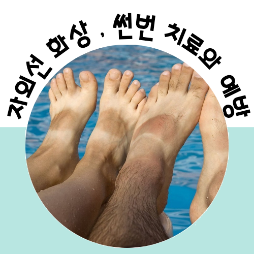  썬번 치료 그리고 예방 알아보아요.