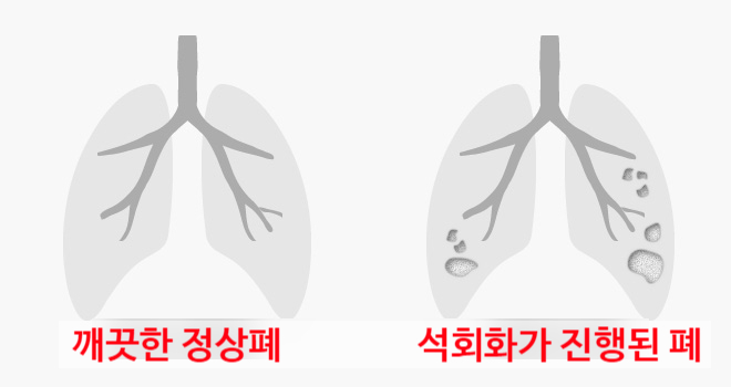 폐섬유화 증상과 치료 알아보기