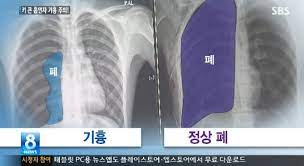 호흡기계 국가고시공부 기흉종류 원인증상 혈흉 폐수종 연가양흉곽 심장압전 성인간호학 호흡기계 국가고시공부 기흉종류 원인증상 혈흉 폐수종 연가양흉곽 심장압전 성인간호학