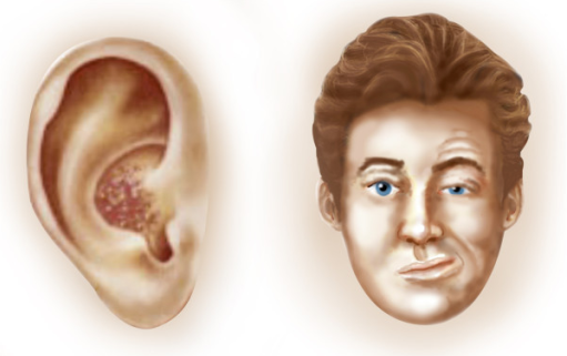 람세이헌트 증후군, Ramsay-Hunt syndrome(RHS) 귀대상포진 herpes zoster oticus, HZO