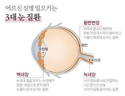 노인성안질환이란 노안뜻 노화원인증상 진단치료 렌즈돋보기안경 노년기