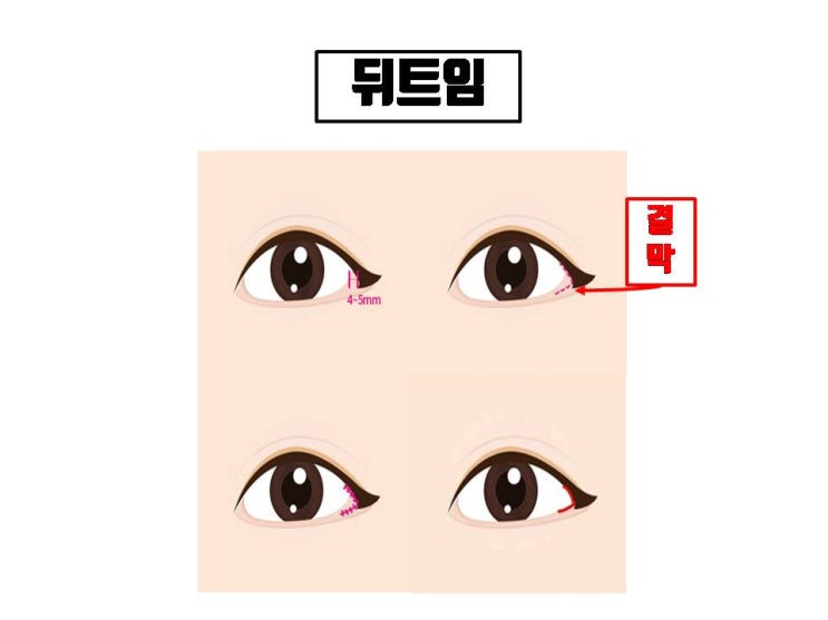 앞트임, 위트임, 뒤트임, 밑트임은 알겠는데 듀얼트임, 복합트임은 뭘까요?