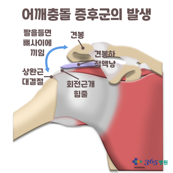  [창원마산 척추관절 디스크 365병원] 어깨충돌 증후군