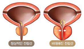  쏘팔메토효능 전립선비대증 원인대표증상 진단검사 중년남성 야뇨빈뇨