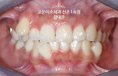  [성인교정] 덧니, 정중선이 돌았어요/발치교정