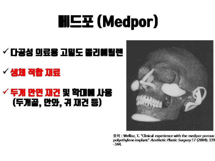  아직도 메드포어 (Medpor)를 이용해 코수술하는 성형외과가 있나요? 메드포어는 절대로 사용하면 안돼요!!!