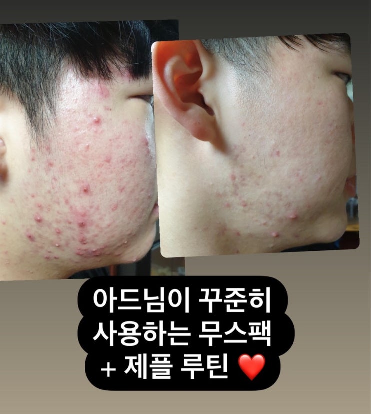  당신의 피부는 무스팩을 알기전 후로 나뉩니다 ! 이 구성 이혜택 어디에도 없어요!!!!