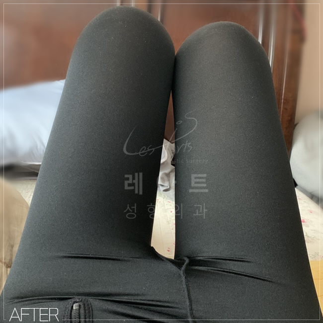  탄력이 떨어지는 허벅지도 레아트는 예쁘게 흡입