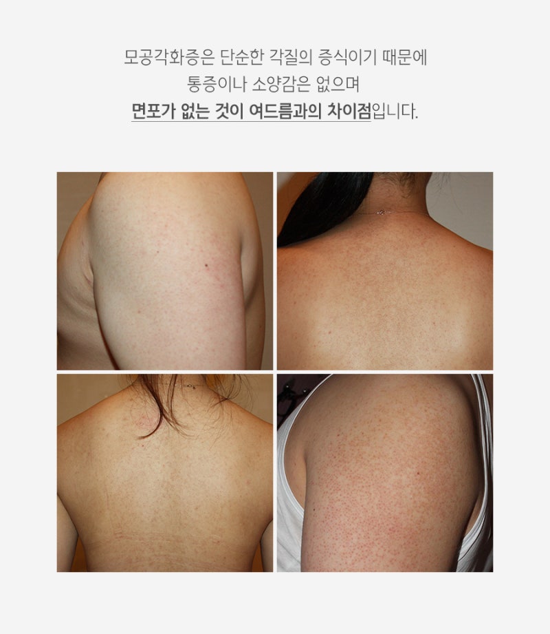 수원가슴여드름 색소침착 없애려면 5