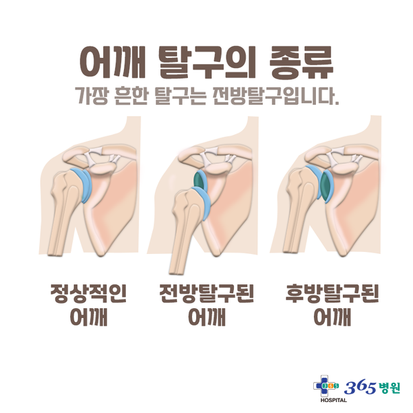 [창원마산 척추관절 디스크 365병원] 습관성 어깨 탈구(재발성 탈구)
