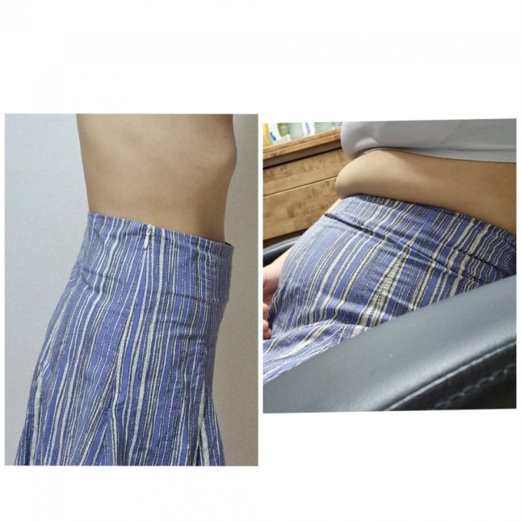  복부지흡 지방빼는주사로 다이어트 성공한 후기