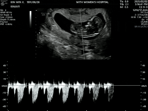 임신초기 성장 기록 : 배아~ 3개월 증상, 초음파