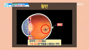 황반변성 당뇨병성망막병증 원인증상 진단치료수술 노인성안구질환 간호케이스 문헌고찰 황반변성 당뇨병성망막병증 원인증상 진단치료수술 노인성안구질환 간호케이스 문헌고찰