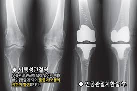  인공관절치환술 적응증목적금기 수술과정순서 장점단점 수술전후간호중재 합병증주의사항