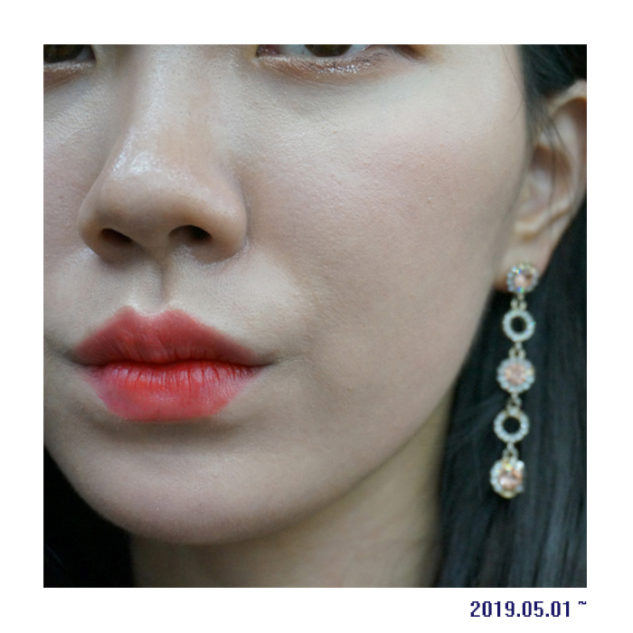  탈 스테로이드 접촉성피부염 극복한 한달간의 기록 (2019년 4월)