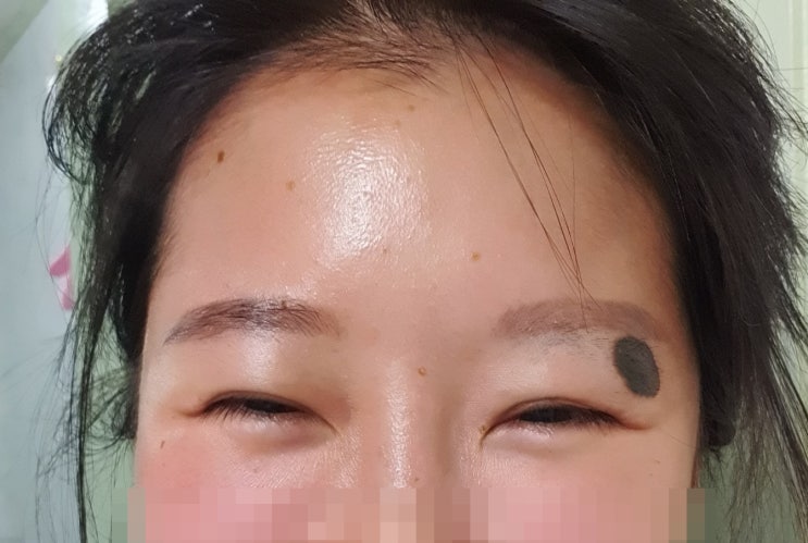  7개월된 큰점 제거 후기