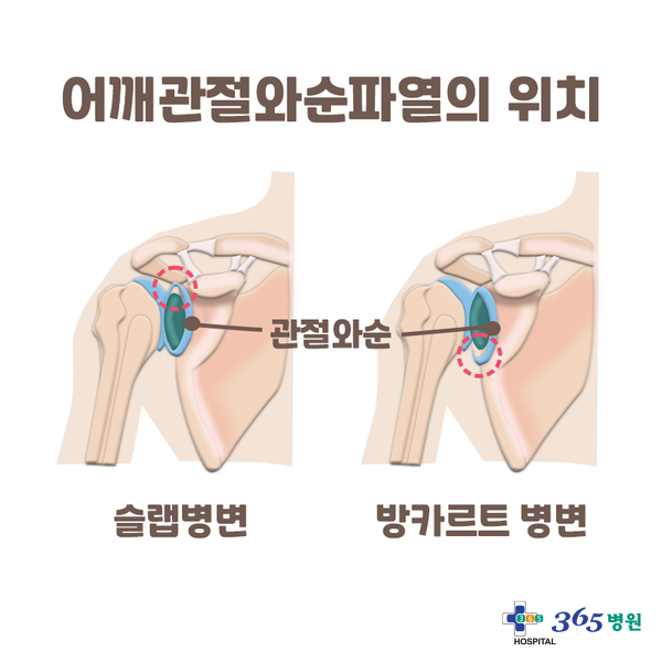  [창원마산 척추관절 디스크 365병원] 어깨관절와순파열