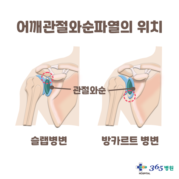 [창원마산 척추관절 디스크 365병원] 어깨관절와순파열