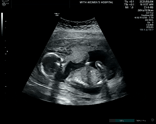 임신중기 성장 기록 : 4개월 ~ 7개월 증상, 초음파