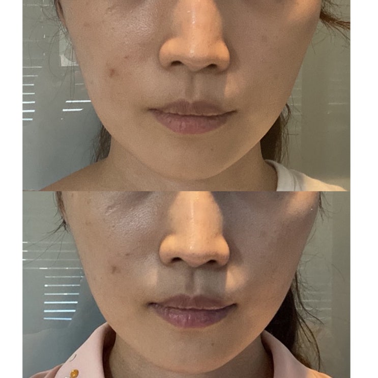  강남역 피부과 튠페이스 잘하는 곳 다녀와 기분 좋았어요