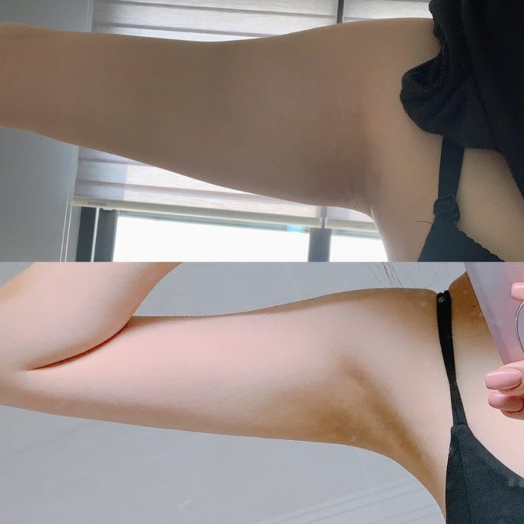  가족,회사 몰래한 팔뚝 지흡 1년째 후기