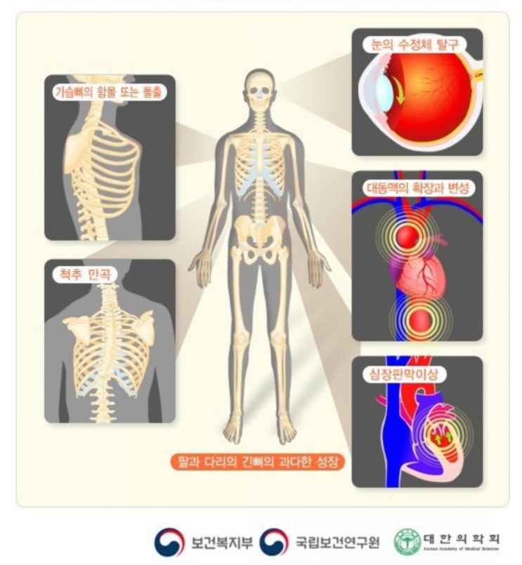 데일리퀴즈 8월1일 마르팡 증후군은 미국의  링컨 대통령이 앓은  질화으로 알려져있이며 긴뼈의 과도한 발율으로 비정상적으로 팔과 다리가 길어지는 신체적 특징을 보인다?