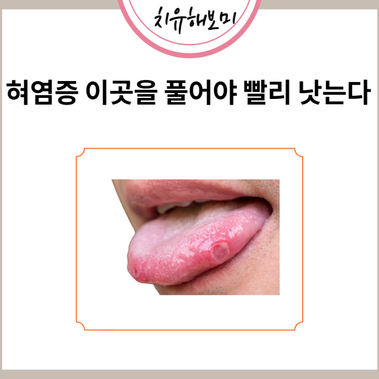  혀염증 이곳을 풀어야 빨리 낫는다
