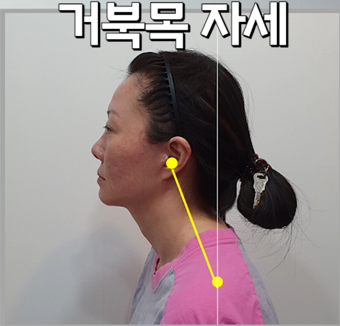 뮤잉운동 부작용 생기는 이유와 그 예방법은? #뮤잉 #뮤잉운동 #하드뮤잉 : 네이버 블로그