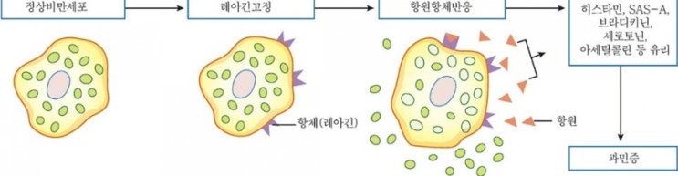 데일리퀴즈 8월2일 알레르기로 인한 급성 전신 반응으로 원인 물질에 노출된 뒤 호흡기 / 순환기 / 피부 등에서 급성 전신 증상이 나타나며 심하면 목숨을 잃을 수도 있는 증상은?