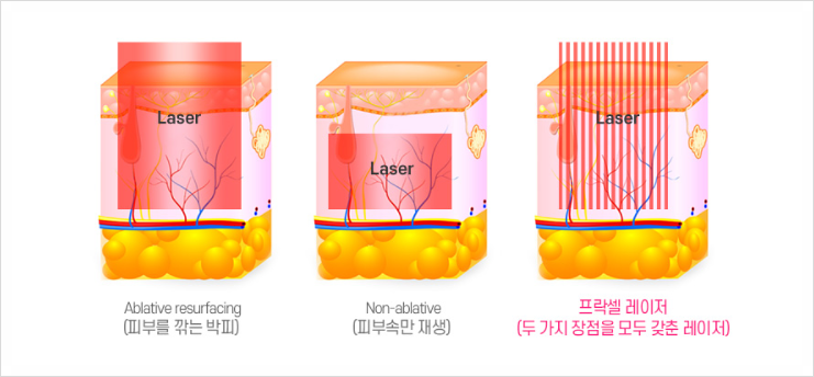  광주 프락셀 레이저? 흉터로 거울 보는 게 두려운 분들만