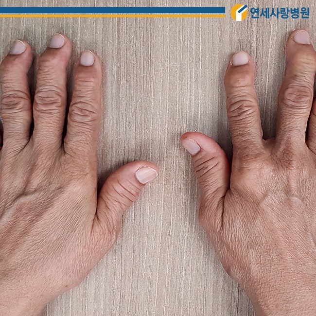 류마티스 관절염 손가락의 증상 및 검사 및 손가락 관절 뼈 통증의 원인 정보 2