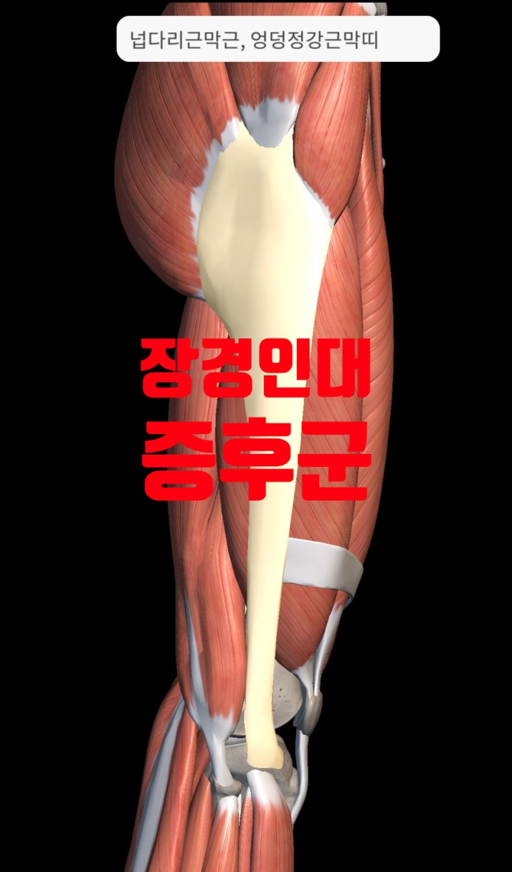  안양야간진료 - 무릎외측 통증 - 자전거나 마라톤을 심하게 하고 나서 생기는 통증 - 장경인대증후군