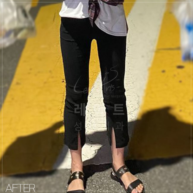  레아트성형외과 근육량 중상 [167cm / 61 kg / bmi 22.1] 허벅지지방흡입 리얼후기사진