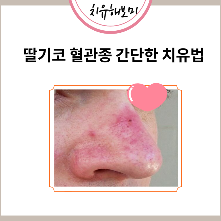 딸기코 혈관종 간단한 치유법