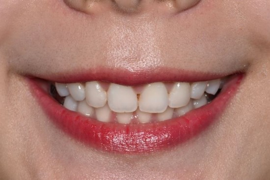 치과에서 받는 치아미백 종류 중 스탠다드 프로그램
