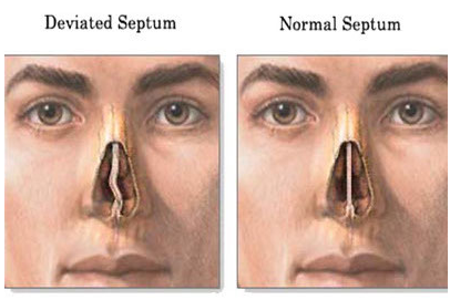 코막힘, 비폐색, Nasal obstruction